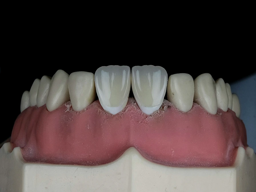 veneers