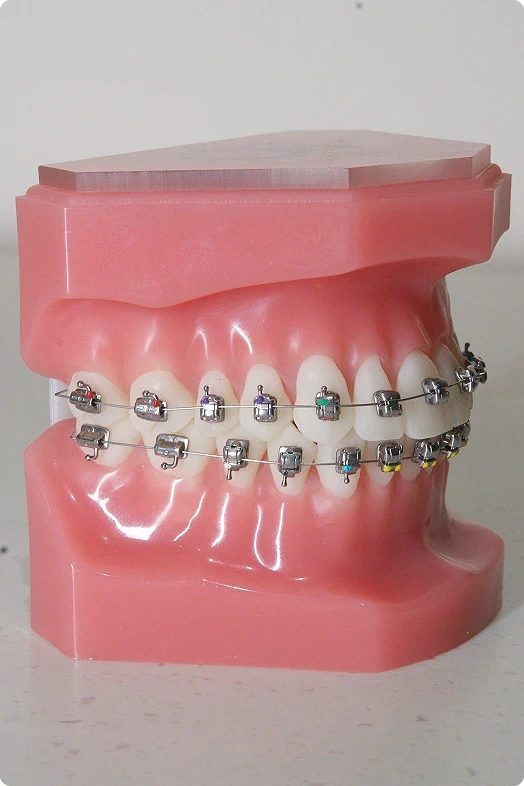 benefits-braces