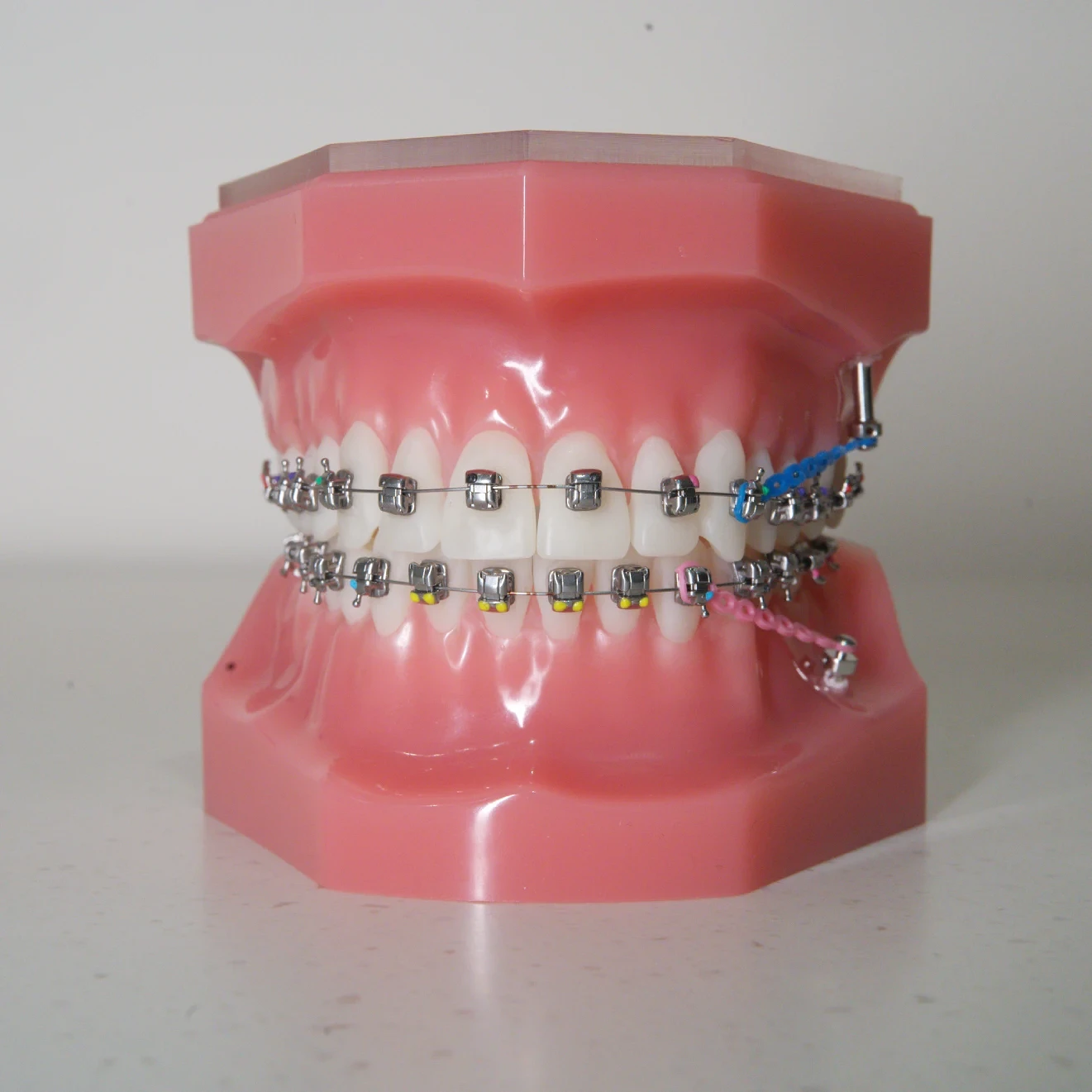 braces