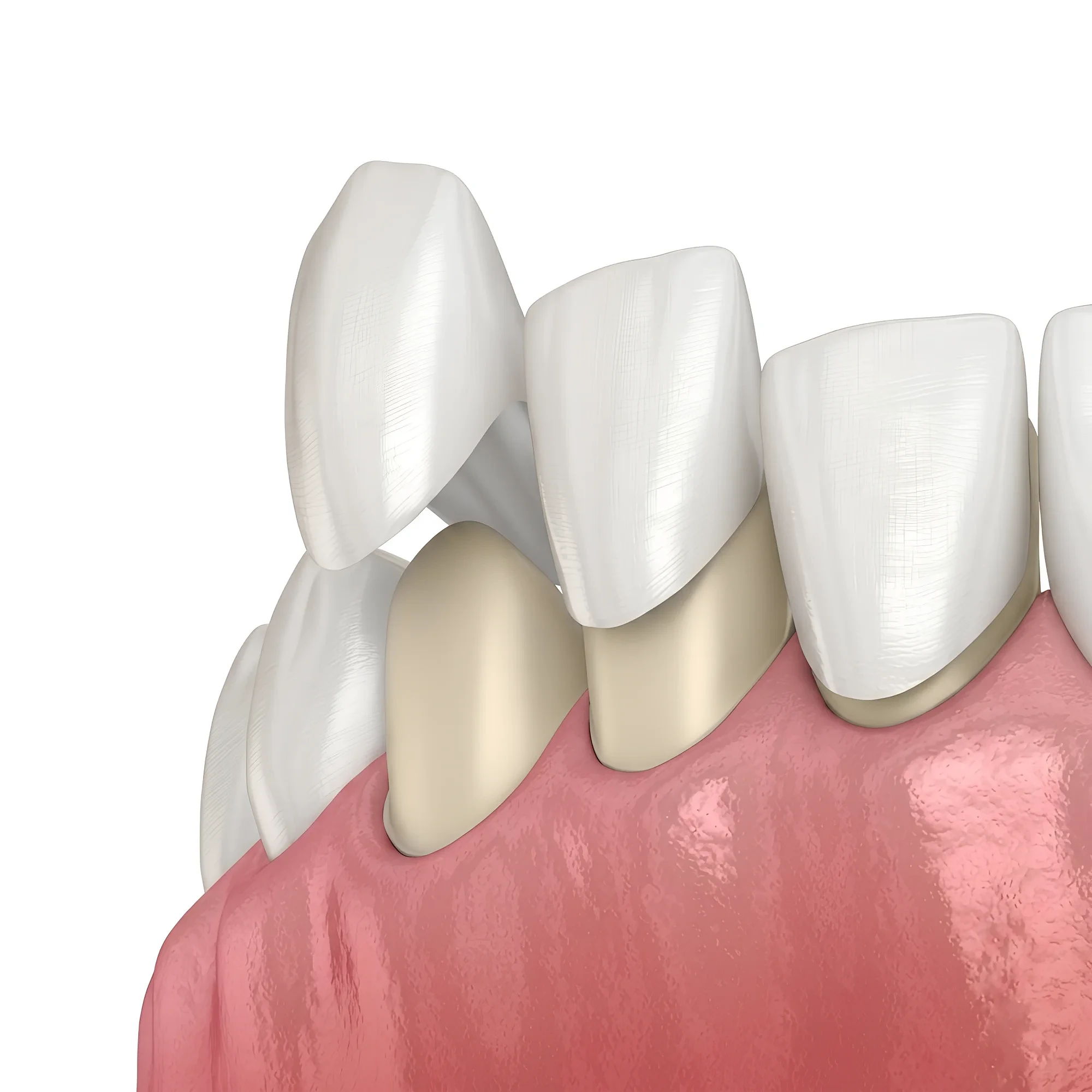 veneers