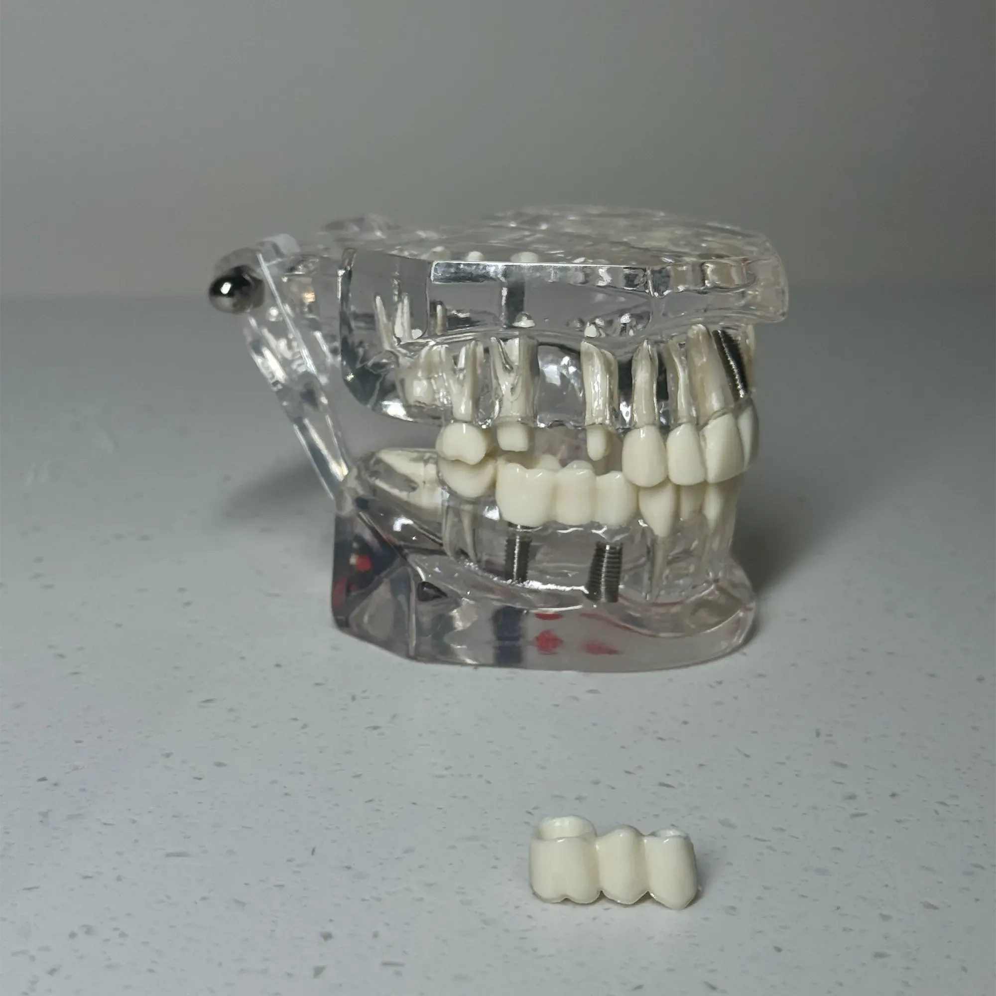 Dental bridge planning at Zenon Dental Clinic with bite and chewing function assessment